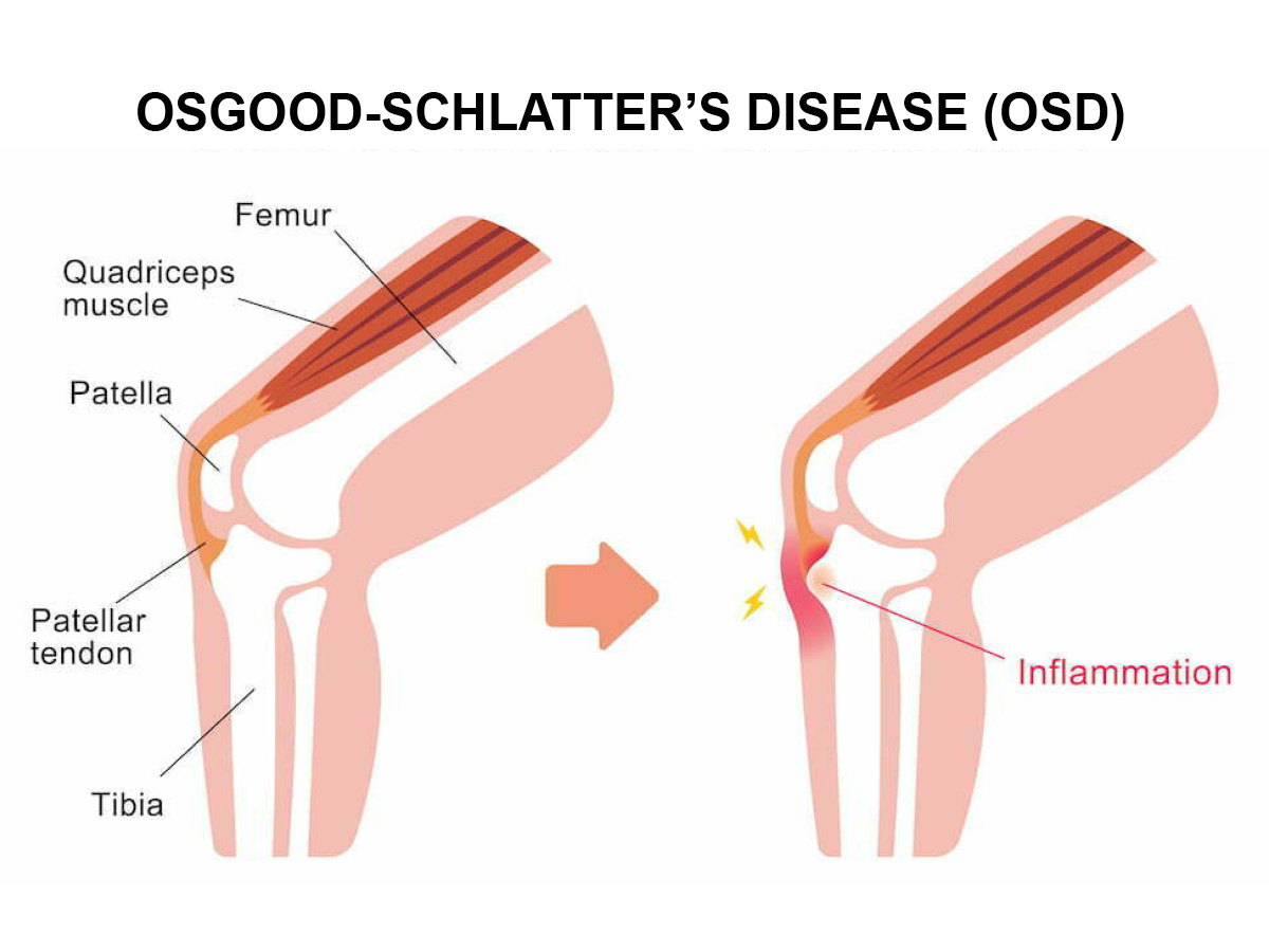 OSD Disease Image