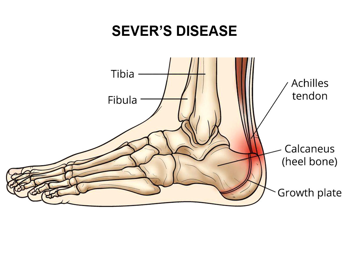 Sever's Disease Image